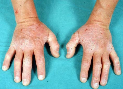 Dermatitis Herpetiformis (Celiac Disease Rash) Photos Gluten Allergy Rash, Rash On Hands, Allergy Rash, Rash Causes, Gluten Allergy, Itching Skin, Skin Hand, Skin Diseases, Food Allergies