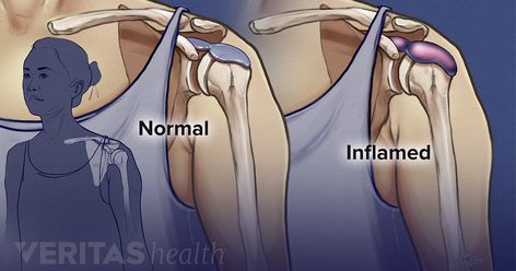 Shoulder bursitis occurs when the bursa in the shoulder becomes inflamed. Shoulder bursitis is closely associated with a condition called shoulder impingement syndrome (sometimes called subacromial pain syndrome). Subacromial Bursitis, Shoulder Bursitis, Bursitis Elbow, Supraspinatus Muscle, Bursitis Shoulder, Shoulder Pain Exercises, Shoulder Problem, Rotator Cuff Tear, Shoulder Impingement