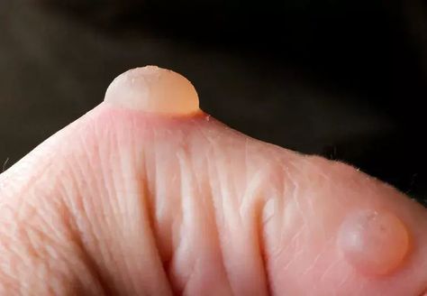 Wherever they came from, the temptation to pop a blister may just get the best of you. But experts say that’s usually not your best bet. Our dermatologist explains why you shouldn’t pop most blisters and how, instead, to treat three common kinds of blisters. Burn Blister, Sinus Massage, Body Forms, Respiratory Illness, Body Form, Itchy Scalp, Massage Techniques, Blow Dry, Skin Conditions