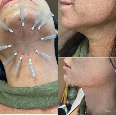 A patient experiencing PDO THREADS treatment at K2 Restorative Medicine Thread Lift Face, Face Threading, Pdo Threads, Beauty Procedures, Thread Lift, Facial Fillers, Injectables Fillers, Facial Aesthetics, Panama City Beach Florida