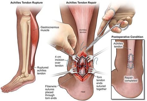 The Achilles tendon is prone to injury and pain due to the enormous demand the body places on it during physical activity and certain anatomical factors that leave it less able to repair itself after injury. Most cases of Achilles pain can be treated through physical therapy and orthotics but when the tendon becomes torn, ruptured or has developed significant scar tissue then Achilles Tendon Surgery becomes an option to discuss with your doctor. Achilles Tendon Repair Recovery, Achilles Tendon Ruptures, Achilles Pain, Ezekiel 37, Ligaments And Tendons, Achilles Tendon, Ankle Pain, Medical Anatomy, Surgery Recovery