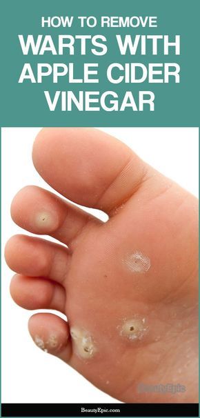 Get Rid Of Corns, Migraine Remedies, Corn Removal, Warts On Hands, Home Remedies For Warts, Warts Remedy, Holistic Health Remedies, Get Rid Of Warts, Home Remedies For Acne