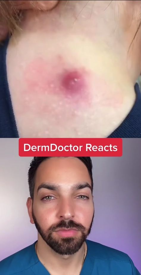 Satisfying Pore Cleaning Videos, Cystic Acne Removal Video, Pore Vacuum Videos, Huge Pimple Poppìng, Satisfying Videos Popping Pimples, Oddly Satisfying Videos Blackheads, Armpit Pimples, Huge Blackheads Extraction Videos, Oddly Satisfying Videos Pimples