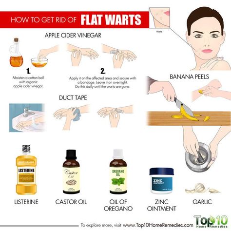 How to Get Rid of Flat Warts | Top 10 Home Remedies Flat Warts On Face, Warts How To Get Rid Of, Apple Cider Vinegar Warts, Face Warts, Flat Warts, Warts On Hands, Warts On Face, Home Remedies For Warts, Remove Skin Tags Naturally