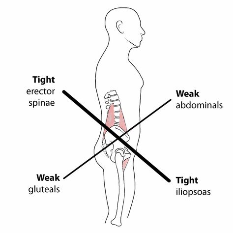 About Your Condition – Lower Crossed Syndrome   Your posture plays an important role in your overall health. Poor posture leads to chronic strain and discomfort. “Lower crossed syndrome” is poor posture that results from excessive tightness in your lower back and hip flexor muscles with weakness in your abdominal and buttock muscles. Patients with lower crossed syndrome often have a “sway back.”   Need help setting up an ergonomic workstation? Use this handy guide 👇  https://chiroup.com/wp-cont Lower Cross Syndrome, Ergonomic Workstation, Fascia Lata, Sway Back, Small Group Training, Rehabilitation Exercises, Musculoskeletal Pain, Gluteus Medius, Muscle Imbalance