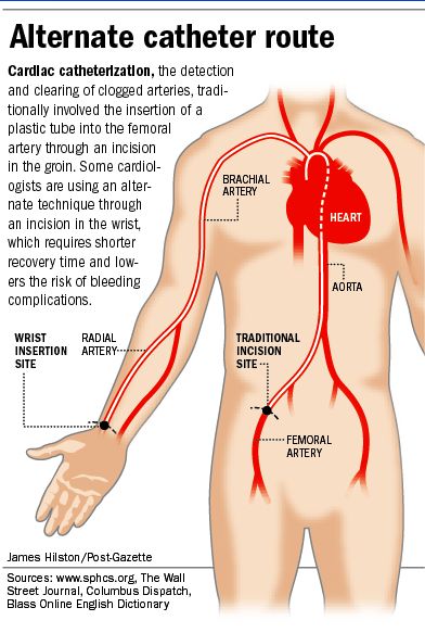 Cardiac catheterization Cardiac Cath Lab Nurse, Cath Lab Nursing, Cardiac Cath, Cath Lab Nurse, Heart Catheterization, Vascular Ultrasound, Cardiac Nursing, Human Body Anatomy, Medical School Studying