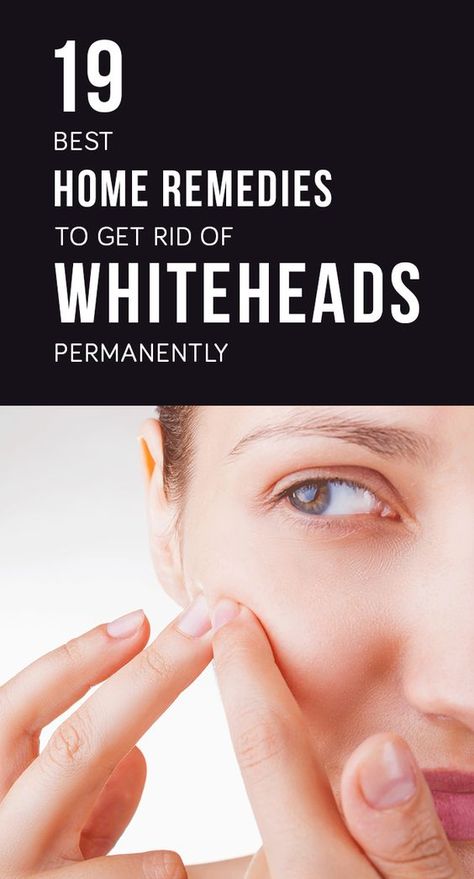 Do you want to get rid of these whiteheads ? Are you unhappy with this unhygienic way you look? Fight whiteheads successfully by following these remedies. Whiteheads Remedy, Warts On Face, Skin Care Routine For 20s, Fall Makeup Looks, Anti Aging Tips, How To Apply Makeup, Simple Skincare, Skin Care Regimen, Blackheads