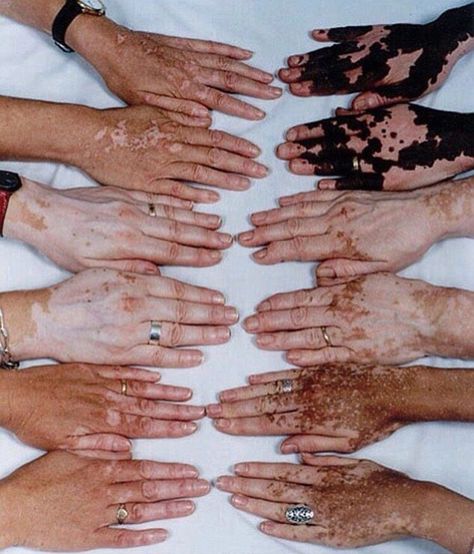 Vitiligo contrast hands Muzică Rock, Kunst Inspiration, Body Positivity, Character Inspiration, Pretty People, Beautiful People, Body Art, Art Reference, Art Photography