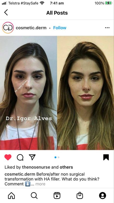 #plasticsurgery #plasticsurgerygonewrong #beforeafter #celebritiesbeforeafter #hollywoodstars #bignosesurgery #surgery #facesurgery #vlinesurgery #koreanplasticsurgery #kpopplasticsurgery #nosejob #jawreductionsurgery #eyesurgery #cheekfillers #rhinoplasty #facelift #plasticsurgeryfails #expensiveplasticsurgery Dimpleplasty Before And After, Liplift Surgery Before And After, Nose Tip Filler, Chin Fillers Before After Round Face, Face Contouring Fillers, Armonizacion Facial, Facial Contouring Surgery, Plastic Surgery Fails, Filler Face