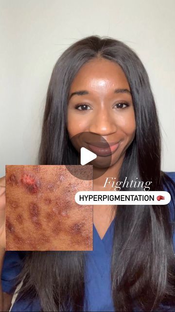 Tyrosinase Inhibitors, Post Inflammatory Hyperpigmentation, Keratosis Pilaris, Lighten Dark Spots, Acne Solutions, Acne Care, Unclog Pores, Kojic Acid, Improve Skin Texture