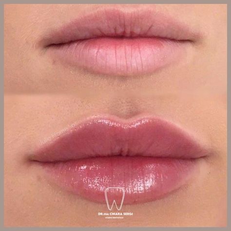 Lip Injections Natural Look, Lip Filler For Hydration, Lip Fuller Shapes, Light Lip Injections, Simple Lip Fillers, Different Types Of Lip Fillers, Before And After Lip Fillers Small Lips, Restalyne Before And After Lips, Lip Blush Natural