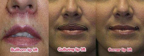 There are three different types of lip lift surgery: 1. Bullhorn lip lift 2. Gullwing lip lift 3. Corner lip lift Learn more: http://www.plasticsurgeryhub.com.au/feature/lip-lift-surgery/ #LipLiftProcedure #LipliftSurgery #LipAugmentation #PlasticSurgery Lip Lift Surgery, Lip Lift, Lip Augmentation, Facial Plastic, Upper Lip, Plastic Surgery, Different Types, Surgery, Facial