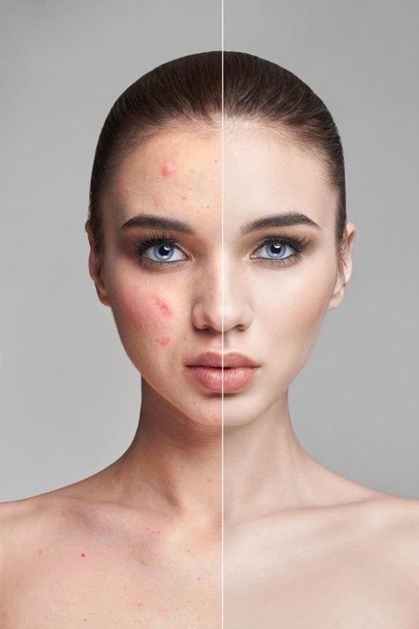 Before And After Acne, Acne Women, Acanthosis Nigricans, Forehead Acne, Pimples Under The Skin, Acne Overnight, How To Get Rid Of Pimples, Acne Facial, Petroleum Jelly