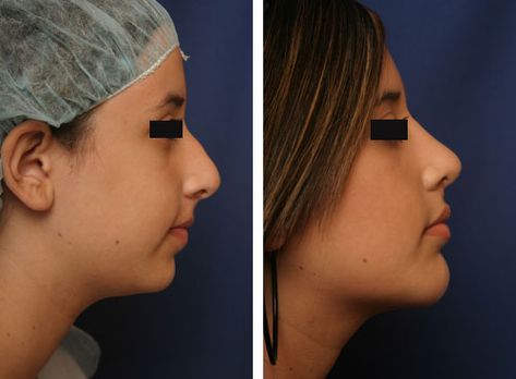 Chin Surgery, Chin Augmentation, Chin Implant, Rhinoplasty Nose Jobs, Face Fillers, Rhinoplasty Before And After, Facial Proportions, Skin Needling, Facial Fillers