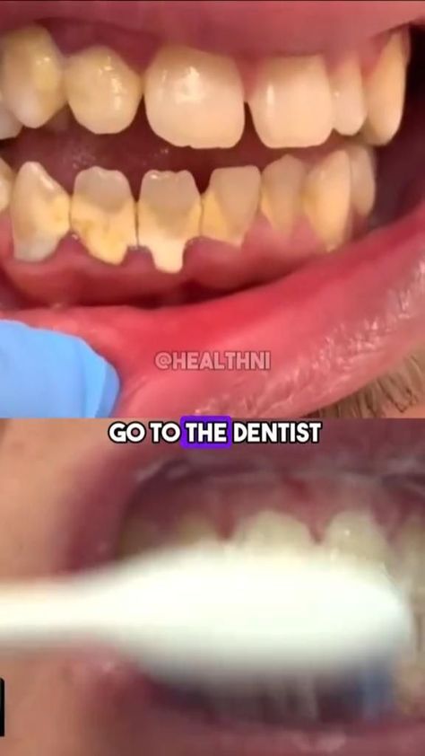 NATURAL RECIPE TO WHITTEN YOUR TEETH Tatoo 3d, Beginner Skin Care Routine, Teeth Whitening Homemade, Face Skin Care Routine, Teeth Whitening Diy, Diy Skin Care Routine, Teeth Health, Quick Workout Routine, Basic Skin Care Routine