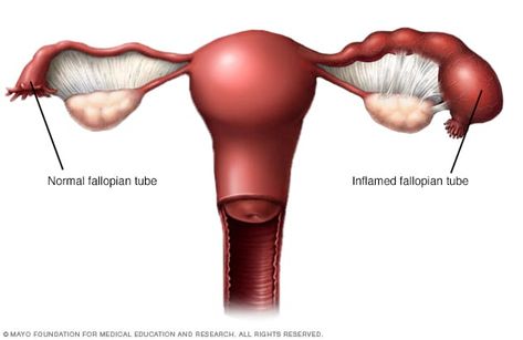 Pid Symptoms, Pelvic Inflammatory, Fertility Testing, Ectopic Pregnancy, Fallopian Tubes, Polycystic Ovaries, Pelvic Pain, Mayo Clinic, Abdominal Pain