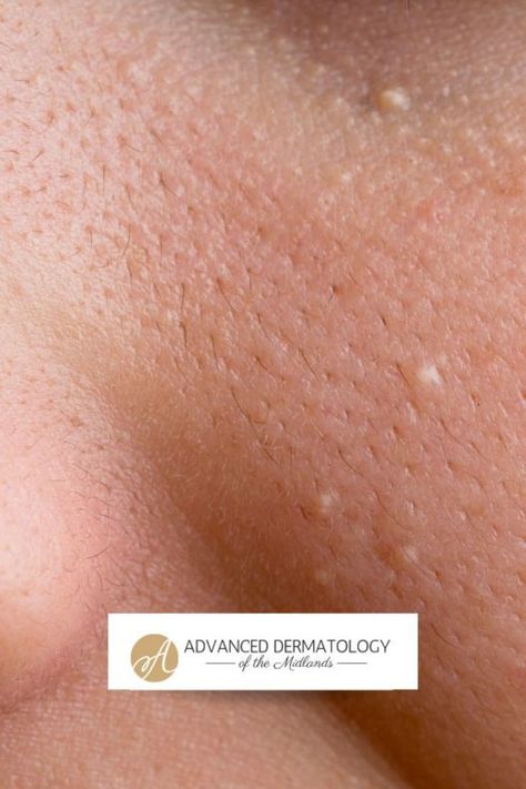 White Bumps On Skin, Skin Bumps On Face, White Bumps On Face, Bumps On Face, Skin Bumps, Holistic Health Remedies, Brown Spots Removal, Skin Spots, Spots On Face