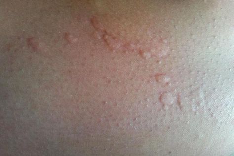 Hives and Food Allergies Information Guide How To Treat Hives, Allergy Hives, Hives Causes, Homemade Pimple Remedies, Zit Remedy, Remedies For Pimples, Natural Remedies For Pimples, Monoclonal Antibodies, Hormonal Breakouts