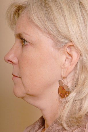 Neck Lift Before & After Pictures - RealSelf Natural Neck Lift, Chin Lift Before And After, Double Chin Before And After, Neck Lipo Before And After, Face Lift Before And After, Neck Lift Before And After, Lower Face Lift Before And After, Sonobello Before And After, Chin Lipo Before And After