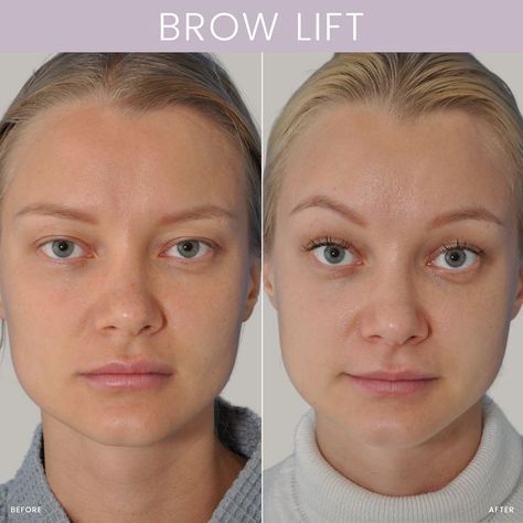 Brow Lift Before and After Eyebrow Lift Before And After, Eyelid Lift Before After, Latisse Before And After, Thread Lift Face Before And After, Botox Eyebrow Lift Before And After, Brow Lift Before And After, Eyebrow Lift Botox Before And After, Botox Brow Lift Before And After, Eyebrow Lift Surgery