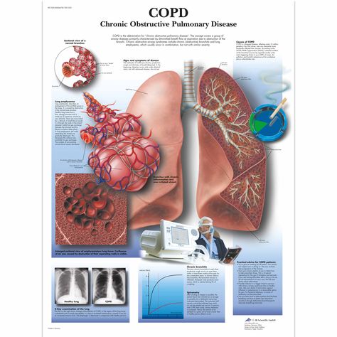 Yoga Chart Posters, Disease Poster, Special Education Behavior, Respiratory Disease, Chakra Chart, Skull Model, Family Tree Chart, Medical Posters, Chronic Obstructive Pulmonary Disease