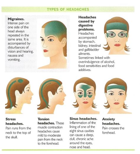 Learn The Different Types Of Dangerous And Serious Headaches... Different Types Of Headaches, Bolesti Chrbta, Headache Types, Reiki Meditation, Migraine Relief, Headache Relief, Migraine Headaches, Medical Knowledge, Health Info