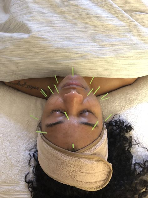 Acupuncture For Acne | POPSUGAR Fitness Comedonal Acne, Back Acne Remedies, Forehead Acne, Acupuncture Clinic, Natural Acne Remedies, Popsugar Fitness, Health Trends, Acne Remedies, Acupressure