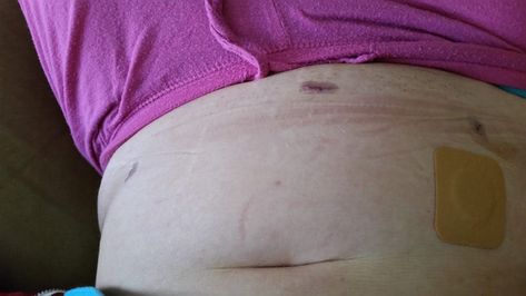 How I healed so fast after surgery and amazed my surgeon Pemf Device, I Healed, Laparoscopic Surgery, Pelvic Pain, Post Surgery, After Surgery, Band Aid, Surgery, I Am Awesome