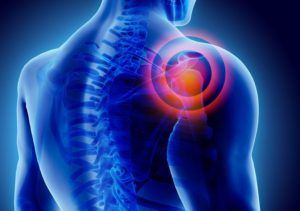 Homeopathy for Frozen Shoulder - Homeopathy Plus What Is Frozen Shoulder, Shoulder Pain Remedies, Rotator Cuff Injury, Shoulder Brace, Frozen Shoulder, Rotator Cuff, Shoulder Pain, Muscle Pain, Sore Muscles