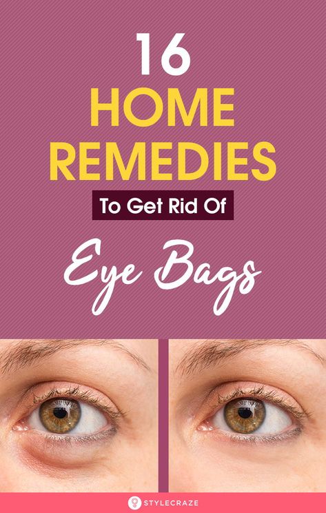 Eye Bag Remedies, Get Rid Of Eye Bags, Rid Of Eye Bags, Puffy Eyes Remedy, Baggy Eyes, Eye Bags Treatment, Cucumber Slices, Under Eye Puffiness, Under Eye Bags