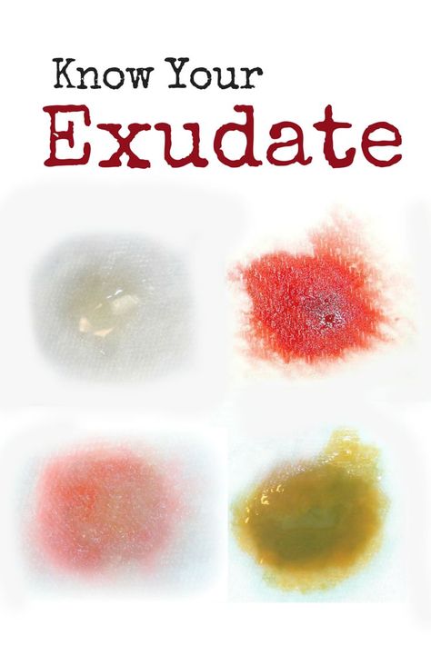 Exudate: The Type and Amount Is Telling You Something. Wound care clinicians… Nutrition Nursing, Career And Technical Education, Wound Care Nursing, Wound Care Dressings, Home Health Nurse, Nursing School Prerequisites, Nursing Cheat, Nursing Board, Hospice Nurse