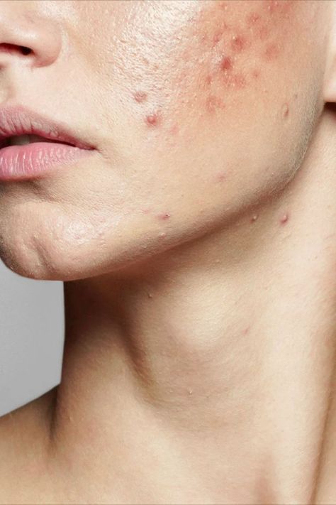 acne Acne Aesthetic, Acne Photos, Skin Breakouts, Stubborn Acne, Remove Skin Tags Naturally, Acne Overnight, Acne Face, Natural Acne Remedies, Skin Acne