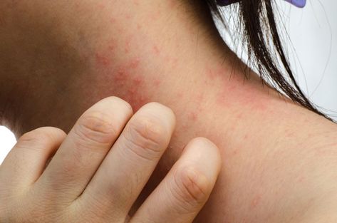 Allergic Contact Dermatitis: Itchy Redness - most common causes of allergic contact dermatitis (ACD), with the chemicals/fragrances included in shampoos and conditioners Hair Dye Allergy, Orange Power, Itchy Rash, Anti Itch Cream, Best Lotion, Scaly Skin, Skin Disorders, Itchy Skin, Skin Problems