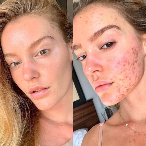 A MODEL who battled chronic acne for two years has revealed her  incredible skin transformation after changing her  diet. Georgia Gibbs, who comes from Perth in Western Australia, suffered from outbreaks of spots on her forehead, cheeks and chin. The Sports Illustrated model shared shocking before and after photos of how her skin has changed […] Before And After Acne, Skin Tags, Yoga Facial, How To Get Rid Of Acne, Skin Care Solutions, Acne Skin, Age Spots, Perfect Skin, Dull Skin