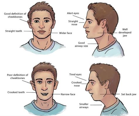 examples-int Mewing Tongue Posture, Tongue Posture, Good Jawline, Jaw Exercises, Jawline Exercise, Myofunctional Therapy, Chiseled Jawline, Mouth Breather, Jaw Surgery