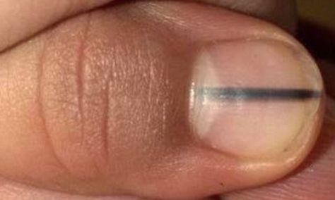 BEAUTICIAN recognised woman's dark nail stripe as deadly disease Nail Health Signs, Fingernail Health, Nail Disorders, Nail Signs, Health Signs, Art Mignon, Lines On Nails, Striped Nails, Dark Nails