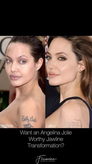 Francine Young, RN, MEP-C on Instagram: "Want an Angelina Jolie worthy jawline transformation 🤗 Try chin filler 💉 To achieve these beautiful results 🥰 #angelinajolie #chinfiller #filler #jawlinefiller" Angelina Jolie Surgery, Angelina Jolie Nose Job, Angelina Jolie Nose, Angelina Jolie Plastic Surgery, Sr Y Sra Smith, Skin Removal Surgery, Chin Filler, Chin Augmentation, Jaw Surgery