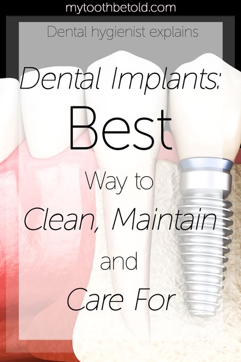 Dental Implants Before And After, Dental Hacks, All On 4 Dental Implants, Implants Dental, Dental Quotes, Denture Implants, Best Dental Implants, Dental Implant Surgery, Dental Anatomy