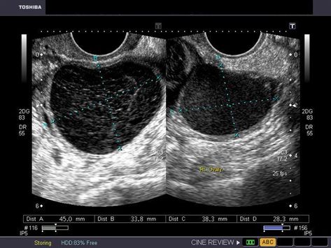 hemorrhagic-cyst-chocolate Bicornuate Uterus, Diagnostic Medical Sonography Student, Gender Reveal Ultrasound, Obstetric Ultrasound, Pregnancy Tattoo, Sonography Student, Radiologic Technology, Ultrasound Sonography, Medical Ultrasound