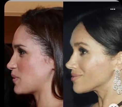 main-qimg-65c5e109fa88e996f3a9408ecc71a50e Megan Markle Nose, Meghan Markle Nose Job, Angelina Jolie Nose, Meghan Markle Plastic Surgery, Jaw Reduction Surgery, Meghan Markle Hair, Rhinoplasty Nose Jobs, Plastic Surgery Gone Wrong, Facial Bones