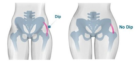 Hips Dips Before And After, What Are Hip Dips, Rid Of Hip Dips, Hip Anatomy, Dip Workout, Handmade Halloween Costumes, Red Spider Lily, Fat Grafting, Hips Dips