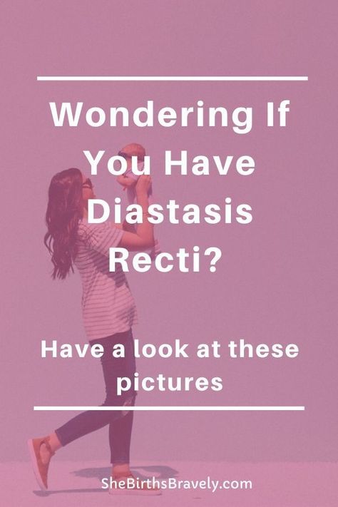 It is possible to heal your Diastasis Recti and lose your Mommy tummy? Need some inspiration? Then have a look at these before and after pictures of women who restored their core by following an exercise program and consistently working out. Click for a visual guide to diastasis recti.  #shebirthsbravely #doula #postpartum #diastasisrecti #mommytummy #fourthtrimester Correcting Diastasis Recti, Exercise Diastasis Recti, Core Exercises For Diastasis Recti, Mommy Pooch Workout Diastasis Recti, Mommy Tummy Before And After, Best Diastasis Recti Exercises, Healing Diastasis Recti Years Later, Diastasis Recti Symptoms, Heal Diastasis Recti Fast