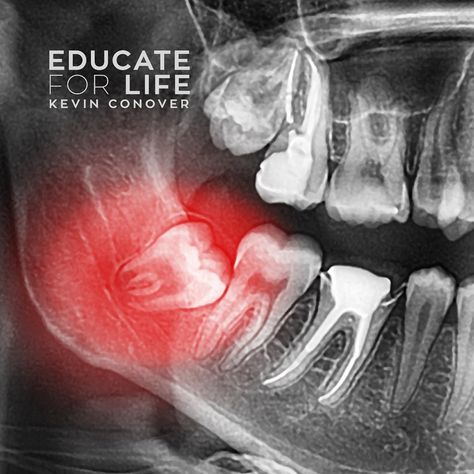 Did you know there are some parts of the human body claimed to have no purpose? From wisdom teeth and our appendix, to tonsils and our tail bone, almost all the features of the human body that have been historically promoted as “non-functional” are now known to have a useful function. In 1893 there were 83 human features considered to be useless leftovers from our ancestral past. It has since been acknowledged that all 83 of these so called “useless features” or vestigial features have legitimat Impacted Wisdom Teeth, Impacted Tooth, Wisdom Tooth Extraction, Discolored Teeth, Oral Surgeon, Family Dentist, Tooth Extraction, Dental Surgery, Best Dentist