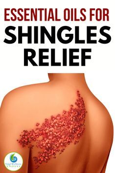 Essential Oils Shingles, Natural Remedies For Shingles, Natural Shingles Remedies, Essential Oils For Shingles Doterra, Shingles Essential Oils, Oils For Shingles, Shingles Pain Relief, Shingles Remedies, Essential Oils For Shingles