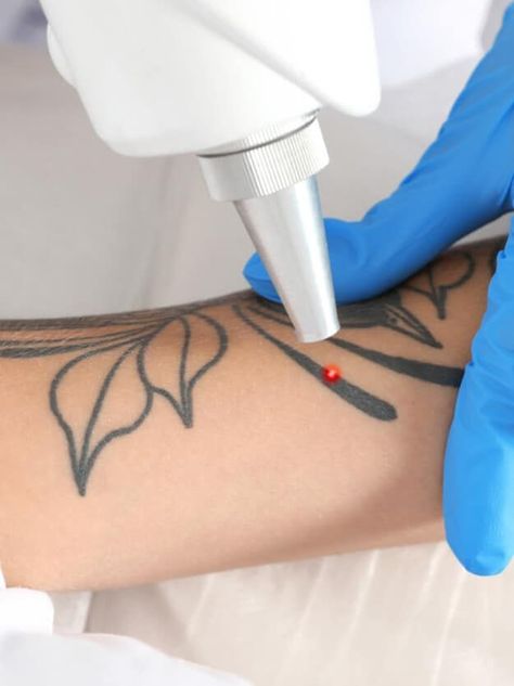 Skin Design Tattoo Removal Tattoo Removal Cost, Tattoo Off, Laser Removal, Laser Hair Removal Machine, City Tattoo, Laser Clinics, Hair Removal Machine, Laser Tattoo, Modern Tattoos