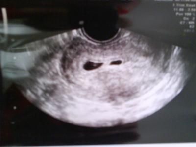 Worried about vanishing twin... I had my first ultrasound at what I though was 6 weeks 2 days.  However the u/s tech told me I was only 5 weeks.  I'm not really worried about that considering Twin Ultrasound 6 Weeks, Twin Ultrasound, Vanishing Twin Syndrome, Vanishing Twin, Mckenzie Foy, Twins Ultrasound, First Ultrasound, Angel Mom, Baby Ultrasound