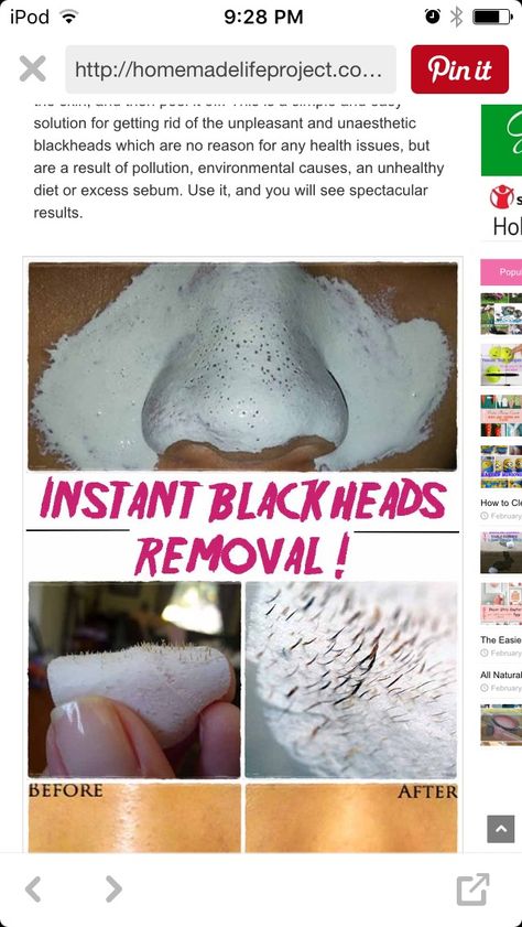 Black Heads Obličejové Masky, Nasihat Yang Baik, Aesthetic Health, Hacks Every Girl Should Know, Blackhead Removal, Remove Blackheads, Get Rid Of Blackheads, Beauty Remedies, Homemade Beauty Products