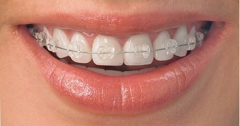 Get It Straight…… Ceramic or Metal Braces!!! Ceramic Braces, Types Of Braces, Invisalign Braces, Adult Braces, Getting Braces, Invisible Braces, Kedokteran Gigi, Clear Braces, Braces Colors