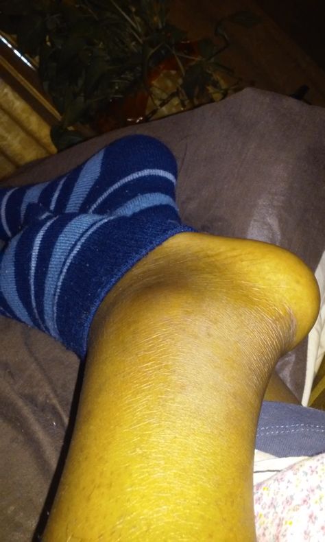 Swollen. looks like a tree trunk.  My first cankle Swollen Legs And Ankles, Swollen Ankles, Broken Ankle, Swollen Legs, Sprained Ankle, Broken Leg, Black Legs, Black People, A Tree