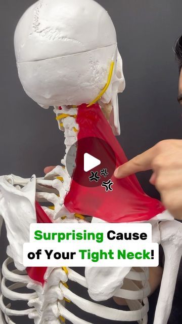 Dr. Joe Damiani - TMJ, Head & Neck Specialist on Instagram: "Comment the word ‘NECK’ on this video if you need help fixing neck or shoulder pain.

Do you experience stifness or pain on one side of your neck? Maybe it moves down to the top of the shoulder, shoulder blade or arm?

Have you also been stretching that tight muscle by pulling in the opposite direction? Maybe you’ve been tight to stretch the upper trapezius or scalene muscles.  This is a very common mistake because while of course there are times when the muscle itself is tight from overuse… Most of the time when the pain has been around for a week or longer there is some type of involvement from the spine. Think about the materials of your spine like a tube of toothpaste if you squeeze it from one side, it puts pressure out to t Lower Trapezius Stretch, Pulled Muscle In Neck, Tight Neck And Shoulders Stretching, Pulled Neck Muscle Remedy, Kt Tape Neck And Shoulder Pain, Neck Stretches For Pinched Nerve, Neck Shoulder Pain Relief, Trap Stretches Neck Pain, Tight Neck Muscles Relief